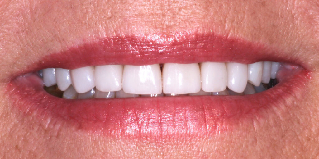 Patient's Mouth After Dental Implants