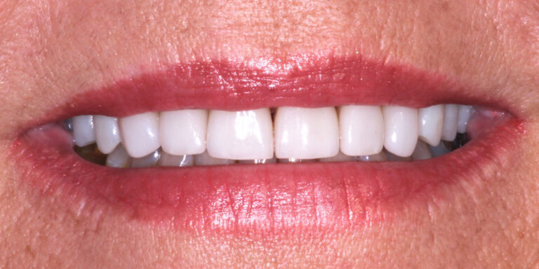 Patient's Mouth After Dental Implants