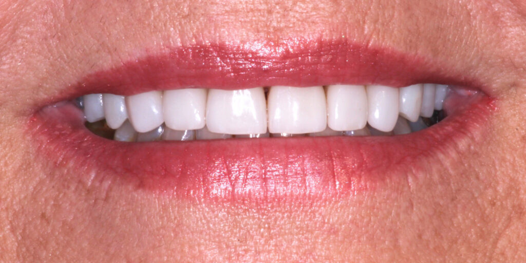 Patient's Mouth After Dental Implants