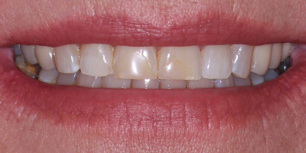 Patient's Mouth Before Dental Implants