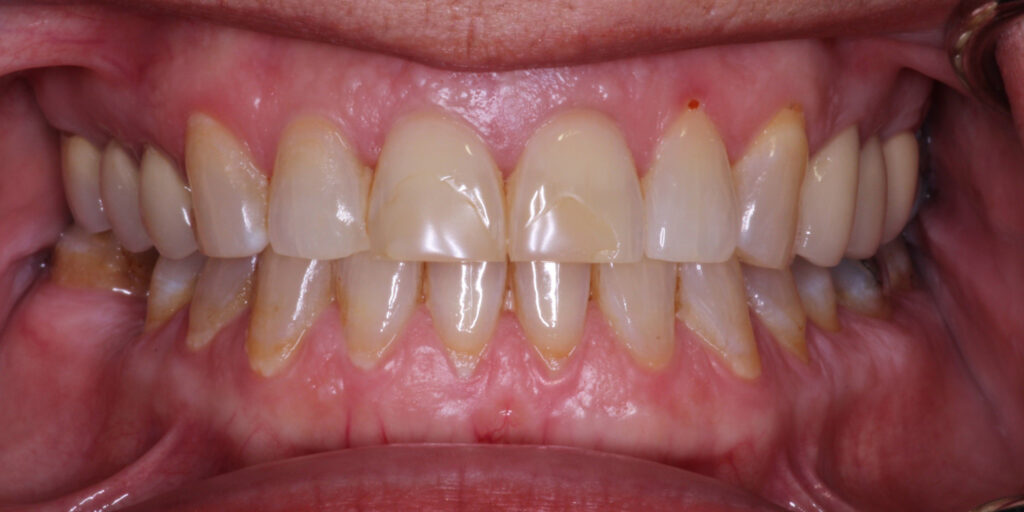 Patient's Mouth Before Dental Implants