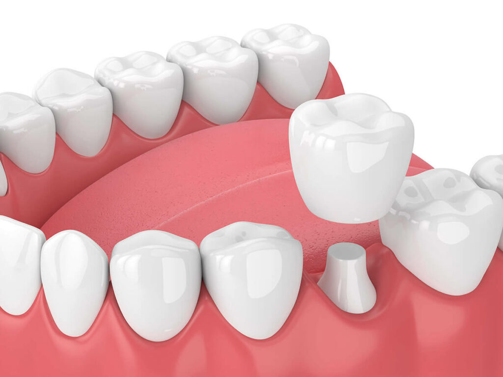 Illustration of a dental crown being placed