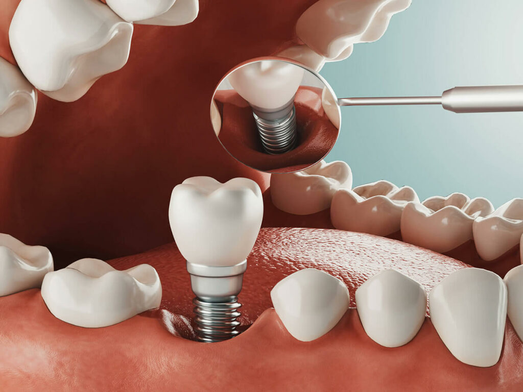 Illustration of a dental implant being placed