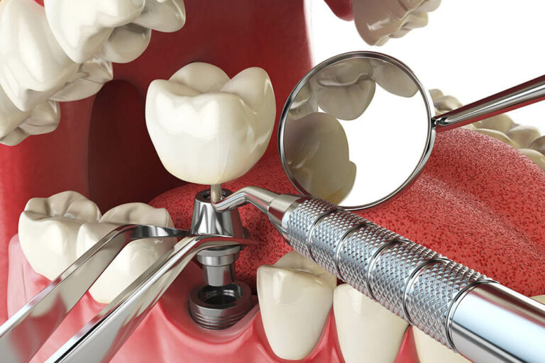 3D illustration of a dental implant being placed
