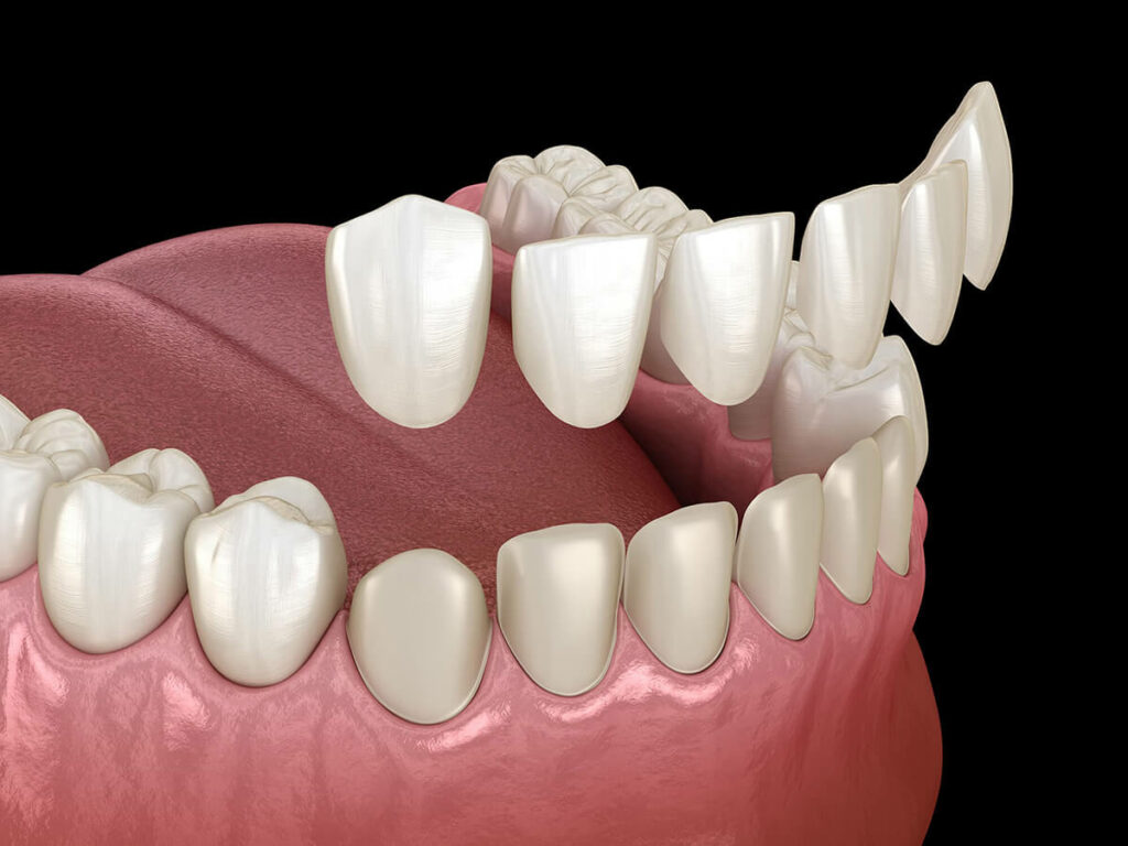 3D illustration of dental veneers fitting over teeth