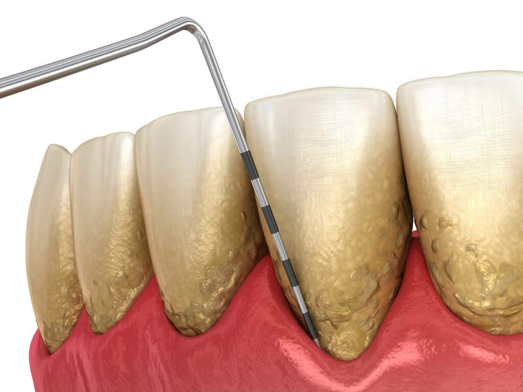 Illustration of diseased teeth and gums