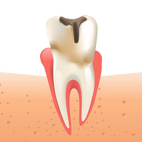 Illustration of a decaying tooth