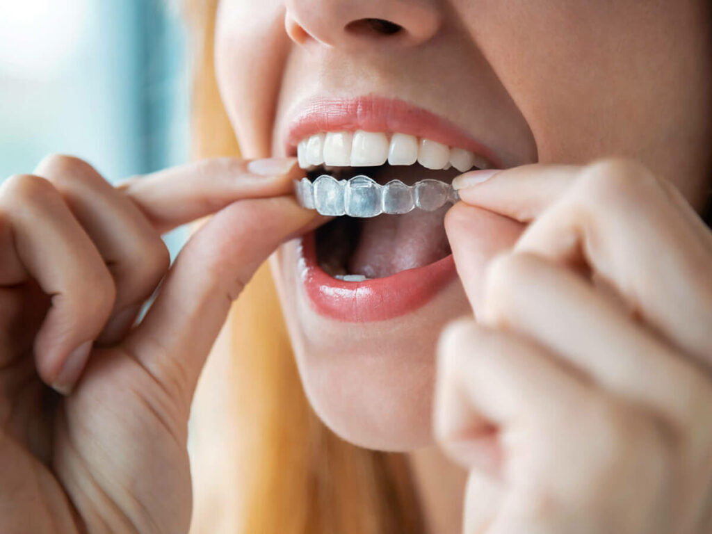 Woman fitting Invisalign clear aligner into upper arch of teeth