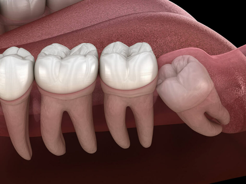 Illustration of an impacted wisdom tooth